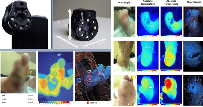 Innovador dispositivo detecta infecciones en heridas con fluorescencia y termografía a través de fotos 