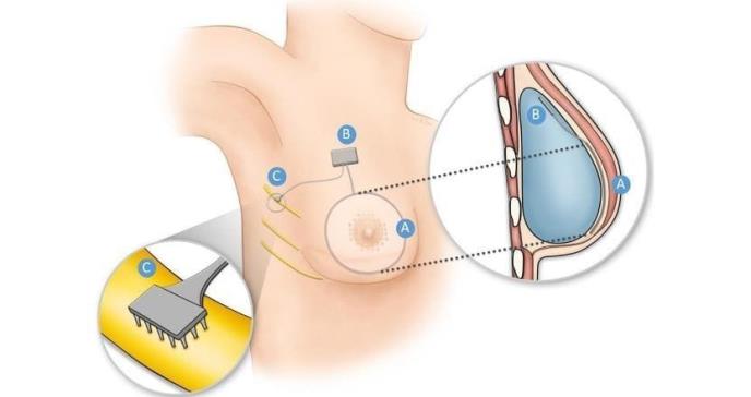 Sensor de presión artificial o pecho biónico podría devolver sensación a mujeres sobrevivientes de cáncer