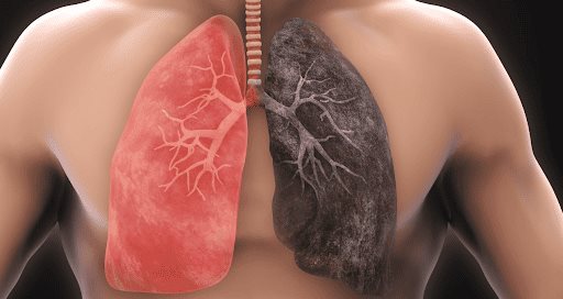 Diferencias y relación entre bronquitis crónica, Enfermedad Pulmonar Obstructiva Crónica y enfisema
