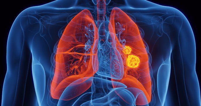 Resistencia en cáncer pulmonar: Investigadores identifican causa genética y proponen innovadora terapia