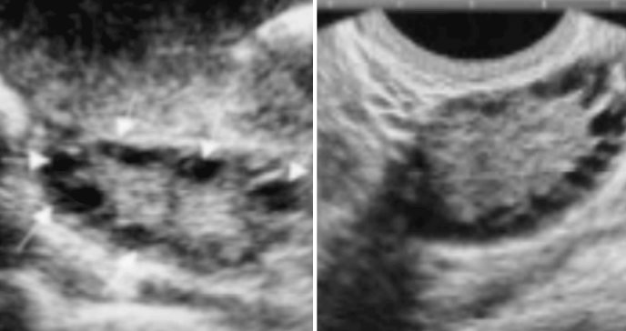 Relación de enfermedades tiroideas y trastornos ginecológicos con el sangrado uterino anormal: estudio