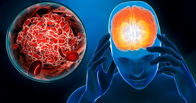 Tratamiento anticoagulante con apixaban disminuye incidencia de accidentes cerebrovasculares