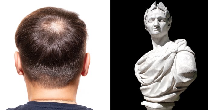 La lucha del hombre para la regeneración del cabello: un camino lleno de técnicas, medicamentos y ciencia