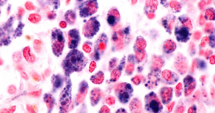 Cáncer provoca senescencia o envejece celularmente al sistema inmune para lograr crear tumores 