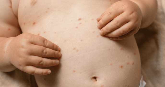 Todo lo que debe saber sobre el sarampión: Una amenaza mundial que preocupa a expertos