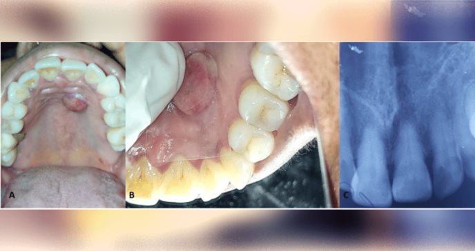 Éxito en tratamiento con láser de un hemangioma capilar en cavidad oral de paciente femenina