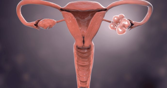 Metabolismo en mujeres con síndrome de ovario poliquístico se masculiniza según estudio