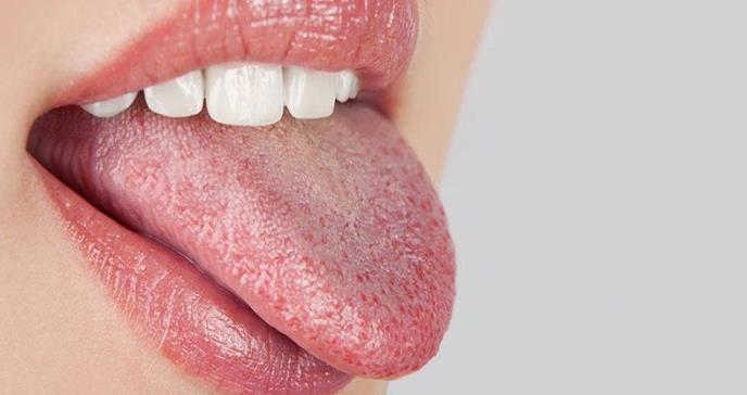 Baja protección contra bacterias, candidiasis oral y otras consecuencias de la sequedad bucal
