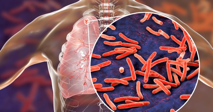 6 claves para diferenciar la Infección de tuberculosis latente y enfermedad de tuberculosis