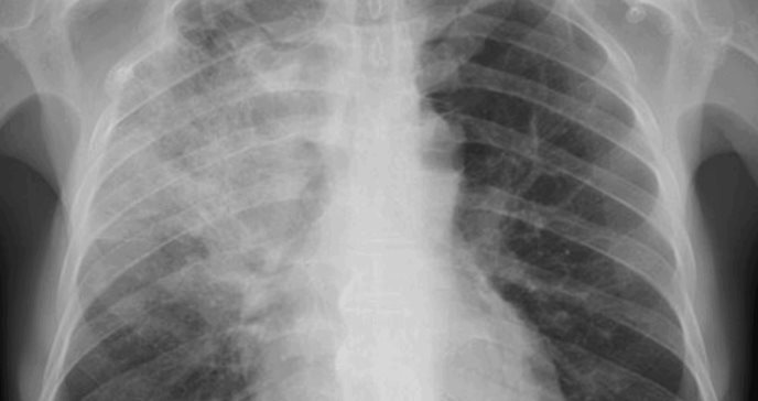 ´Síndrome de pulmón blanco´: ¿de qué se trata el brote de enfermedades respiratorias que azota a China?