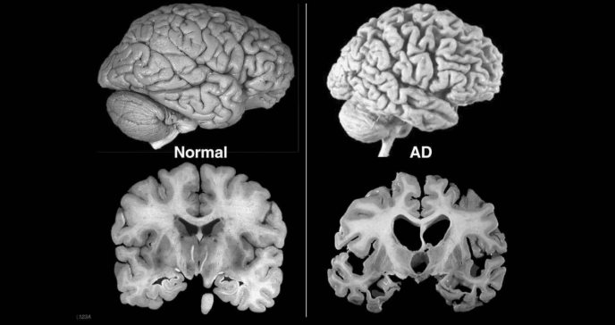 Deterioro cognitivo, alzhéimer y tabaquismo: Fumar encogería el cerebro, según estudio