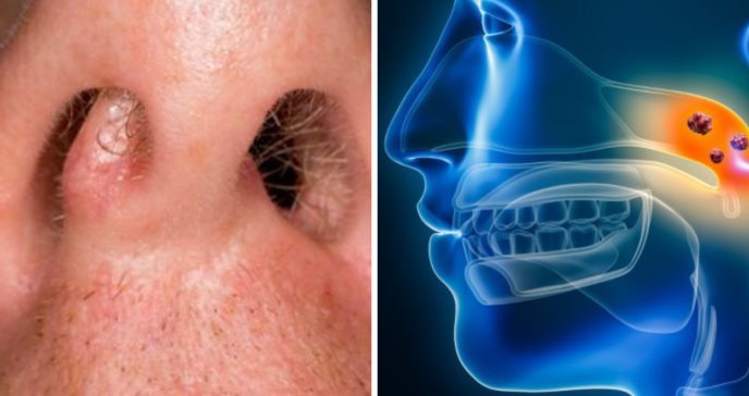 Cáncer nasal y tumores paranasales: ¿Cuándo prestar atención a masas extrañas dentro de la nariz?