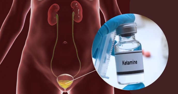 Cistitis hemorrágica, daño irreversible a vejiga y otros riesgos del uso prolongado de Ketamina