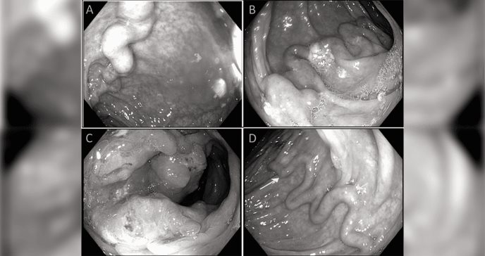 Mujer con hígado graso presenta várices en el colon con masa sigmoidea y arroja positivo a adenocarcinoma