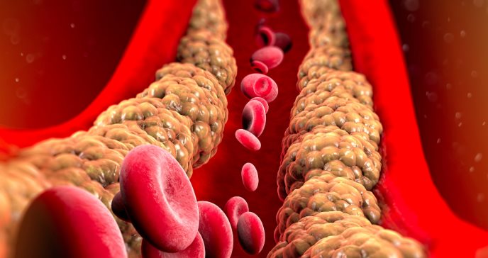Inclisirán: la terapia de ARN que reduce significativamente colesterol LDL con solo 2 inyecciones al año