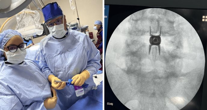 Realizan con éxito el primer implante Vertiflex para estenosis espinal en Hospital Damas