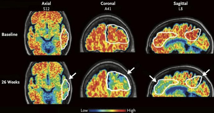 Medicamentos contra el Alzheimer llegan más rápido al cerebro gracias a herramienta con ultrasonido 