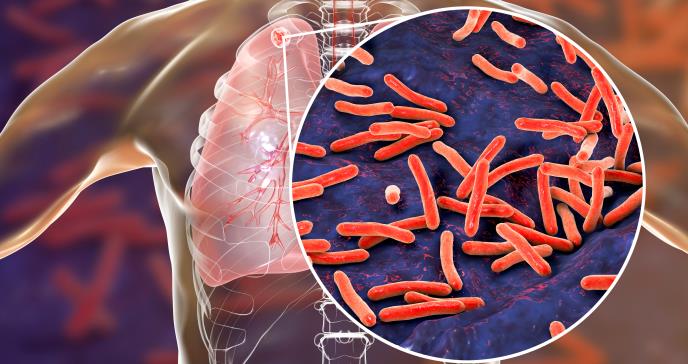 CDC relaciona segundo brote de tuberculosis en Estados Unidos con injertos óseos infectados