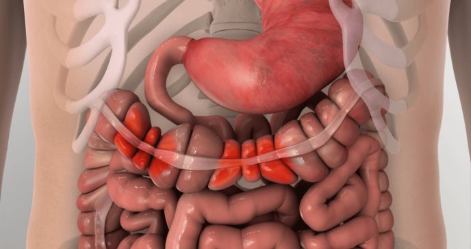 Síndrome del intestino irritable: la condición gastrointestinal más común que afecta a las mujeres