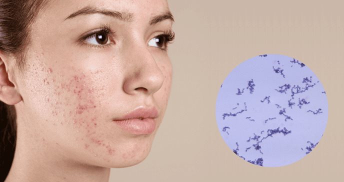 Bacteria ´inteligente´ en la piel podría tratar acné gracias a producción de proteínas terapéuticas
