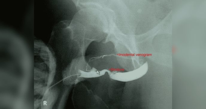 Paciente termina con desgarro uretral de tipo V tras sufrir caída sobre un tronco
