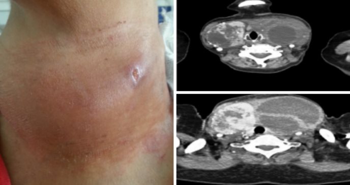 Describen raro caso de enfermedad tiroidea supurativa con nódulo necrotizado por infección de salmonella