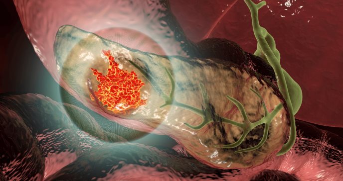Científicos crean modelo innovador para determinar el riesgo de cáncer de páncreas
