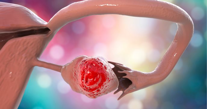 Desarrollan nueva prueba para detectar cáncer de ovario en etapas tempranas con precisión del 93%
