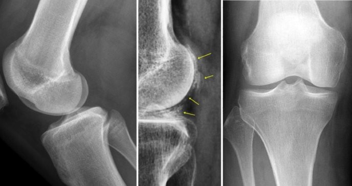 Seudogota elevaría significativamente el riesgo de fracturas, según estudio