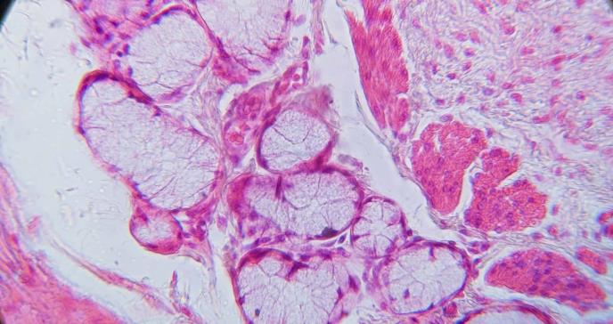 Investigadores crean mapa molecular detallado de la inflamación crónica del esófago