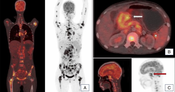 Cáncer gástrico hace metástasis en base del cráneo y produce tumor de Krukenberg en embarazada