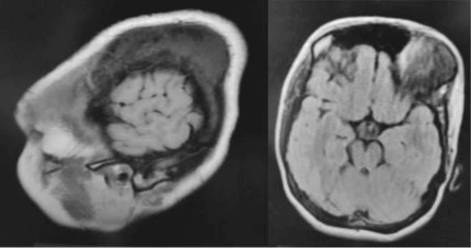 Detectan osteoma craneal en joven con dolor de cabeza tras 18 años de un traumatismo craneoencefálico