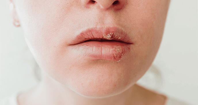 Herpes oral o labial podría duplicar el riesgo de padecer demencia, según estudio