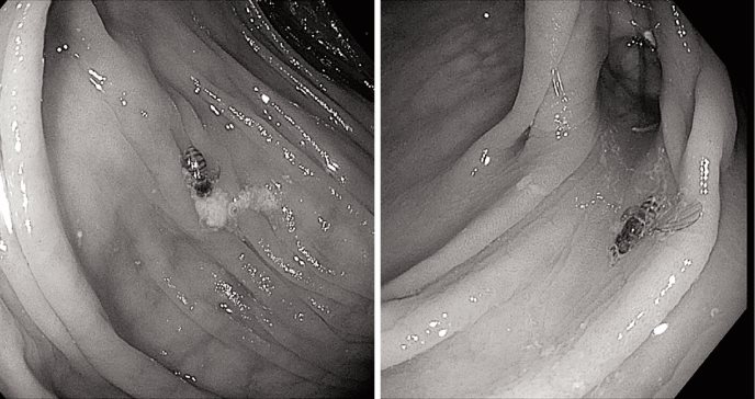 Hallan abeja viva en el colon de paciente con antecedentes de cáncer esofágico durante colonoscopia