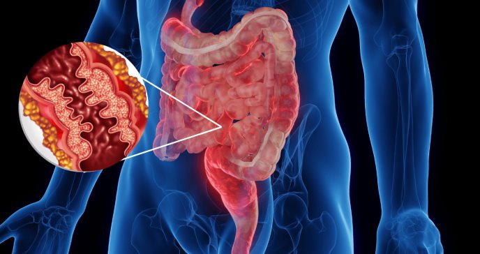 Tratamiento avanzado puede reducir cirugías abdominales para tratar Enfermedad de Crohn