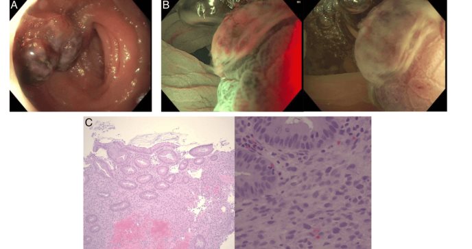 Detectan raro caso de tumor metastásico colorrectal en paciente con cáncer de tiroides