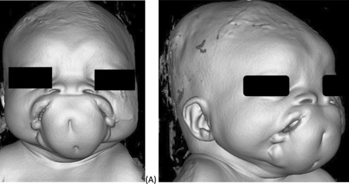 Describen rara duplicación facial o diprosopus en recién nacida: solo hay 36 casos reportados en el mundo