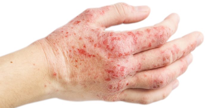 Pacientes con dermatitis atópica tendrían mayor riesgo de padecer colitis ulcerosa o enfermedad de Crohn