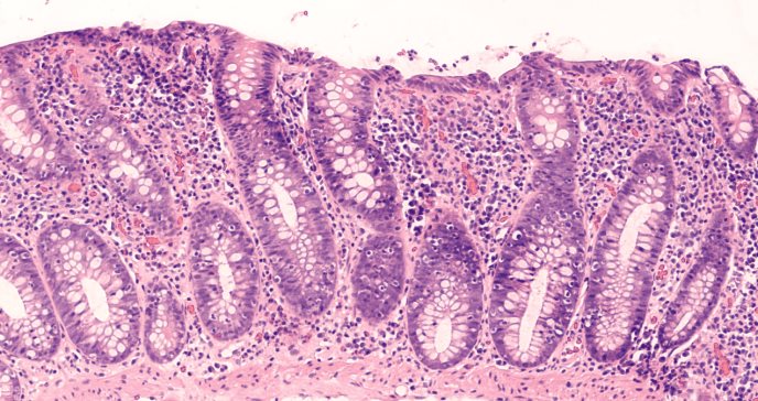 Colitis microscópica: la enfermedad intestinal difícil de detectar que más afecta a mujeres