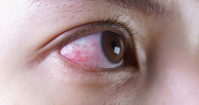 ¿Por qué duelen los ojos luego del eclipse solar? Reconozca los signos de daño ocular o retinopatía solar