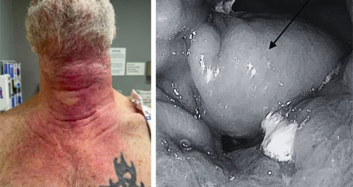 Paciente presenta rara metástasis cutánea de cáncer gástrico con células en anillo de sello