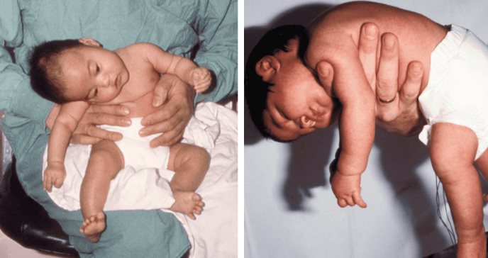 Describen raro caso de botulismo en recién nacida con antecedentes de candidiasis oral y microcefalia