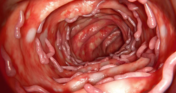 Alimentos ultraprocesados alargan los episodios de colitis ulcerosa y aumentan la inflamación intestinal