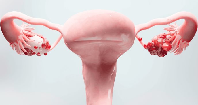 Alta sensibilidad del cáncer de ovario para detección temprana con biopsia líquida o prueba de sangre