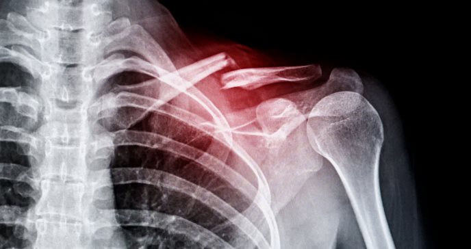 Nueva técnica de irradiación con plasma podría revolucionar la curación de fracturas óseas complejas