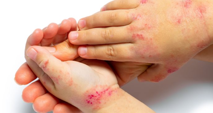 Niños con dermatitis atópica pueden tener mayor riesgo de deterioro cognitivo