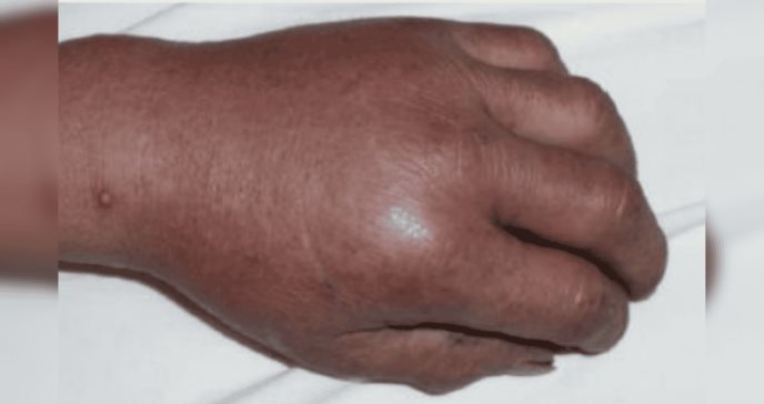 Paciente presenta trombocitopenia y daño renal 18 días después de ser mordido por rata