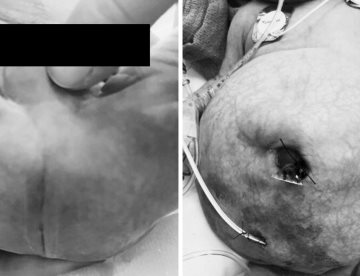 Recién nacida con malformación cloacal requirió reconstrucción del tracto vaginal y colostomía