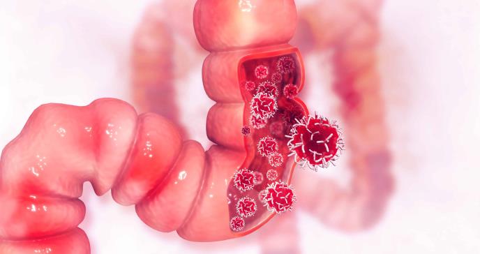 ¿Por qué es tan importante el papel de la intervención nutricional en el cáncer digestivo?
