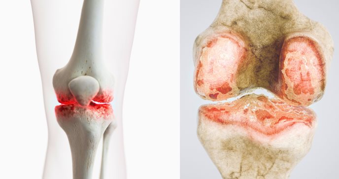 Innovadora prueba de sangre predice la artrosis de rodilla con casi una década de anticipación